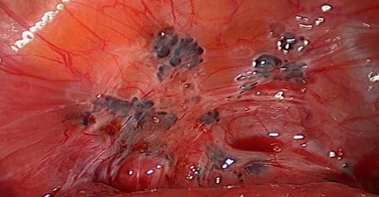 Endometriosis