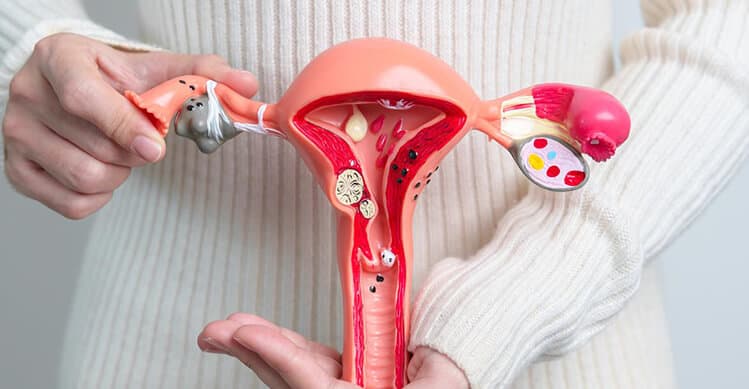 Fibromas uterinos (miomas)