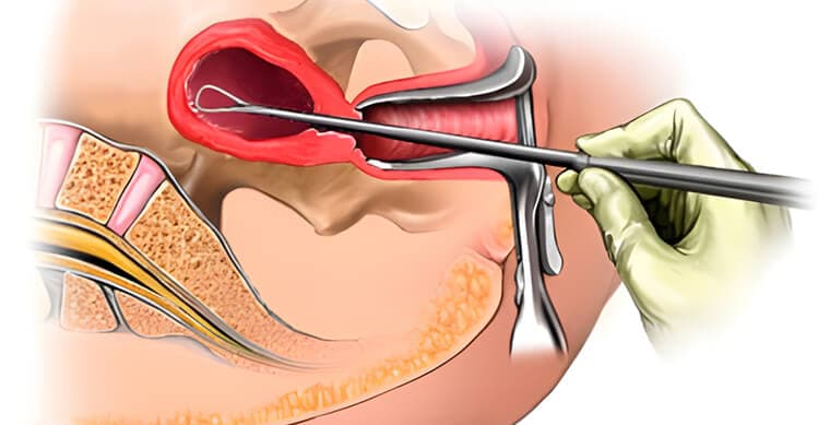 Biopsia de vulva o vagina